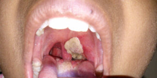 Edo confirms Diphtheria outbreak as two die Diphtheria