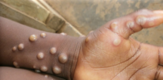 Africa CDC warns of high mpox spread risk across borders mpox, monkeypox