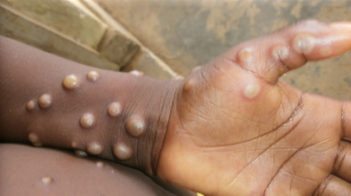 Africa CDC warns of high mpox spread risk across borders mpox, monkeypox