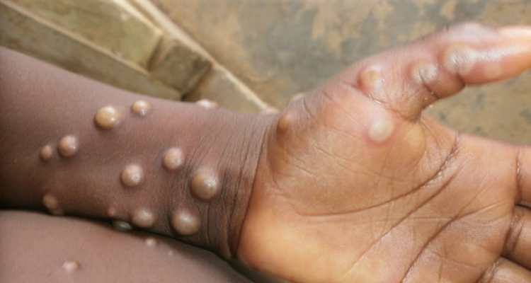 mpox, monkeypox