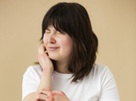 A woman suffering from psoriasis of the hands