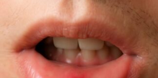 Mouth ulcers and how to treat them naturally, effectively Person pulling down lower lip to show mouth ulcer. Mouth ulcers are often white or yellow in the middle with red around the edges.