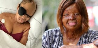 Sosoliso plane crash survivor, Kechi gets corrective eyelid surgery over difficulty blinking Sosoliso plane crash survivor and singer, Kechi Okwuchi