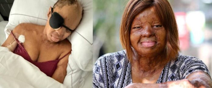 Sosoliso plane crash survivor, Kechi gets corrective eyelid surgery over difficulty blinking Sosoliso plane crash survivor and singer, Kechi Okwuchi